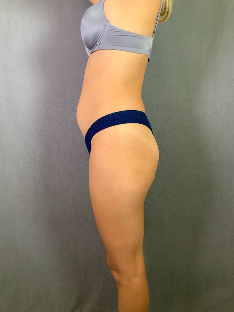 Mini-Tummy Tuck Before & After Gallery - Patient 167403179 - Image 3