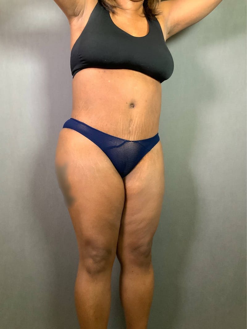 Revision Tummy Tuck Before & After Gallery - Patient 167403183 - Image 4