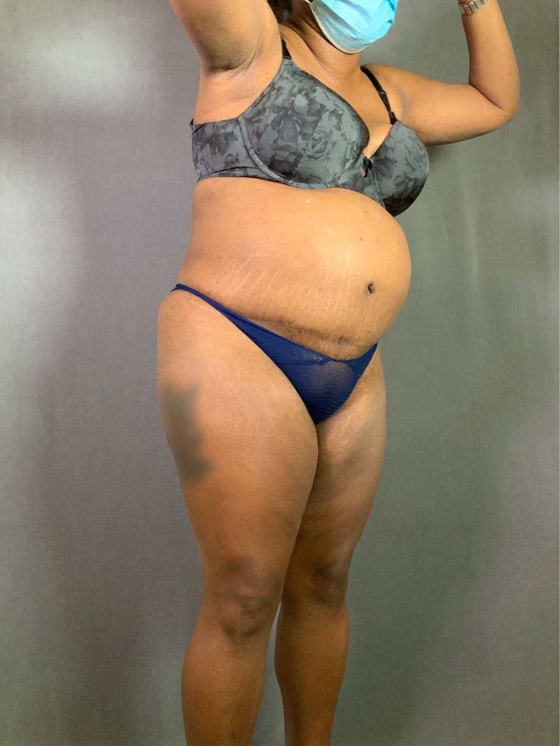 Revision Tummy Tuck Before & After Gallery - Patient 167403183 - Image 3