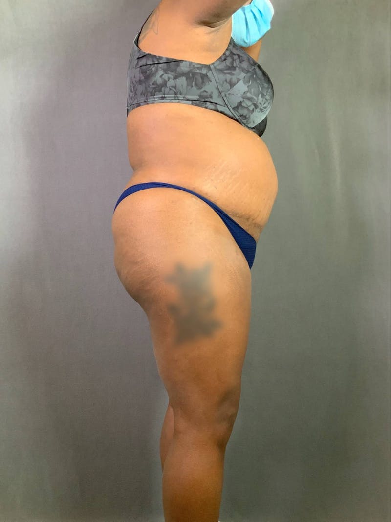 Revision Tummy Tuck Before & After Gallery - Patient 167403183 - Image 5