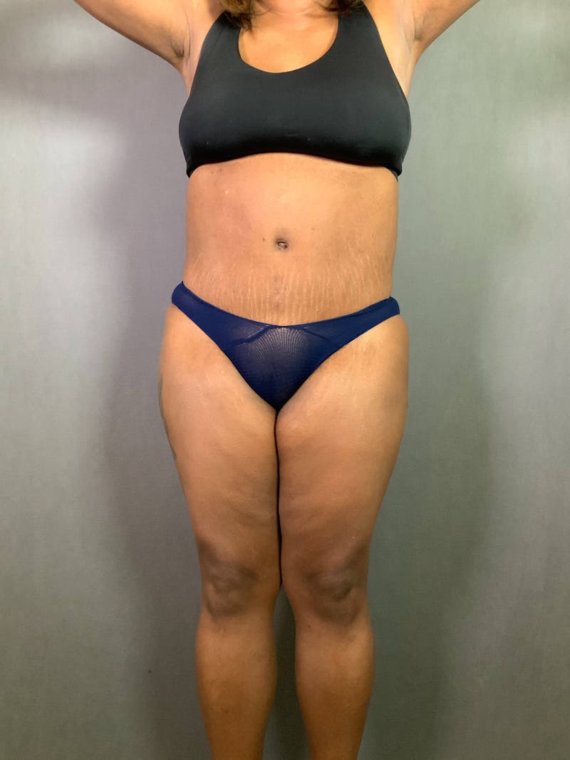 Revision Tummy Tuck Before & After Gallery - Patient 167403183 - Image 2
