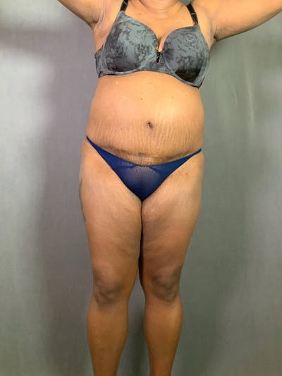 Revision Tummy Tuck Before & After Gallery - Patient 167403183 - Image 1