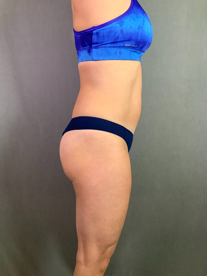 Mini-Tummy Tuck Before & After Gallery - Patient 167403205 - Image 5