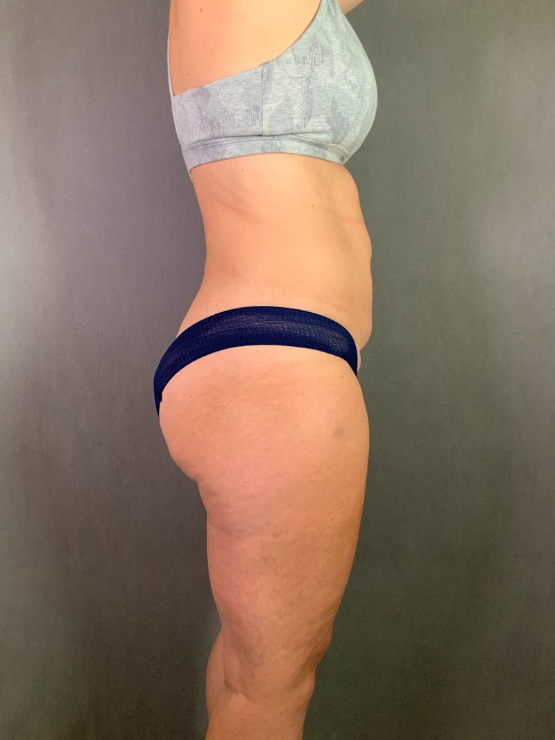 Mini-Tummy Tuck Before & After Gallery - Patient 167403220 - Image 5