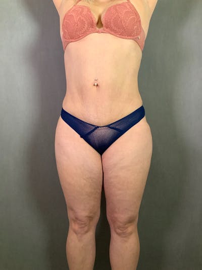 Mini-Tummy Tuck Before & After Gallery - Patient 167403238 - Image 2