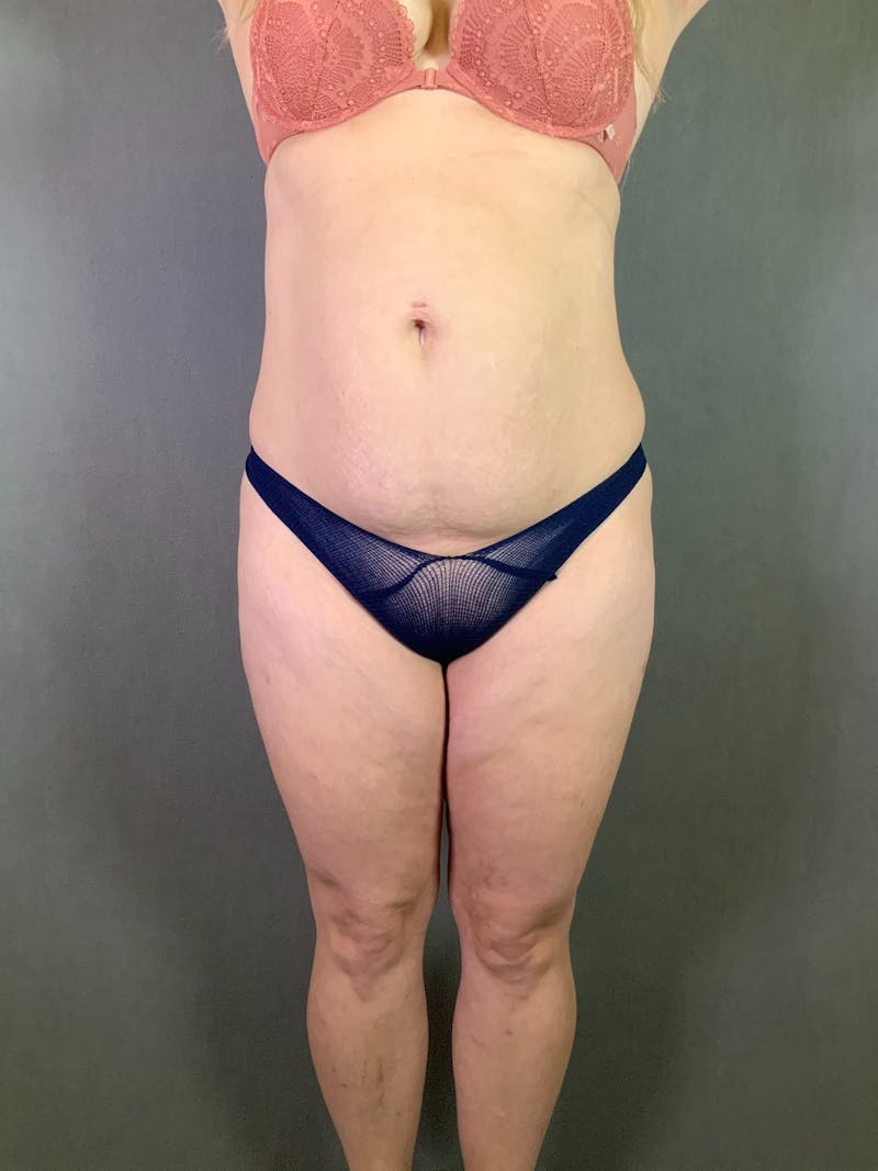 Mini-Tummy Tuck Before & After Gallery - Patient 167403238 - Image 1