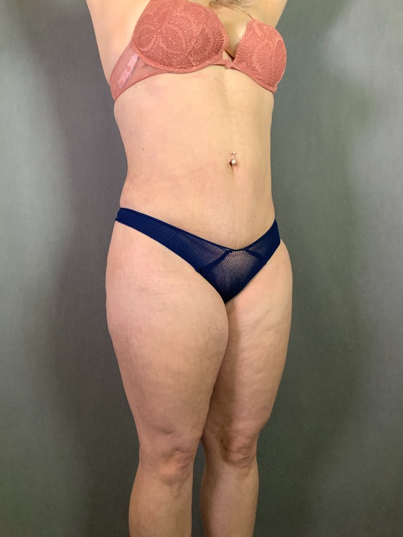 Mini-Tummy Tuck Before & After Gallery - Patient 167403238 - Image 4