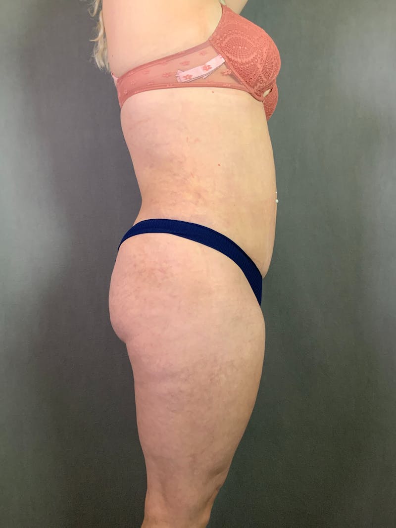 Mini-Tummy Tuck Before & After Gallery - Patient 167403238 - Image 3