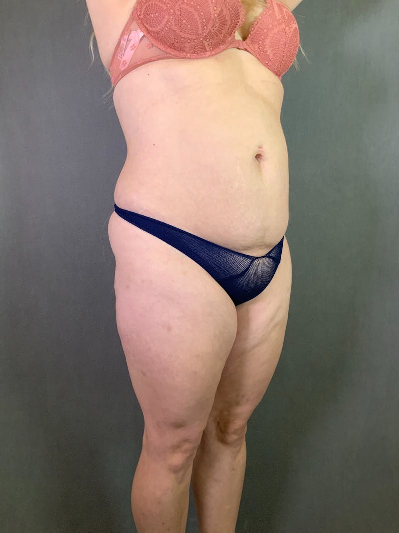 Mini-Tummy Tuck Before & After Gallery - Patient 167403238 - Image 6