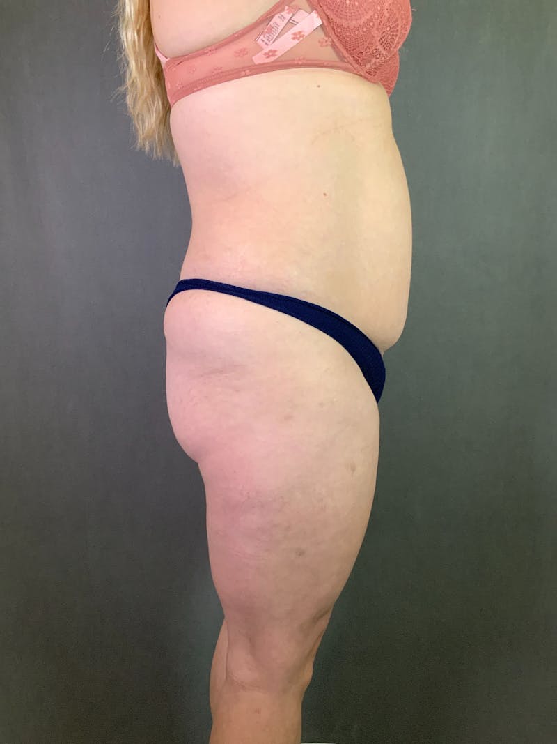 Mini-Tummy Tuck Before & After Gallery - Patient 167403238 - Image 5