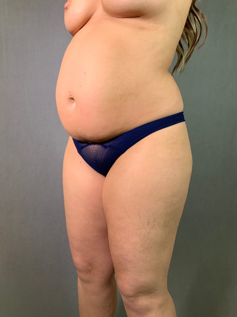 Mini-Tummy Tuck Before & After Gallery - Patient 167403165 - Image 5