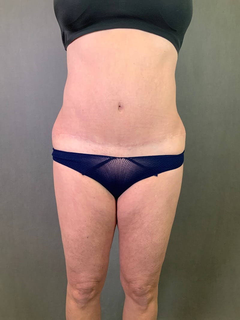Revision Tummy Tuck Before & After Gallery - Patient 167403258 - Image 1