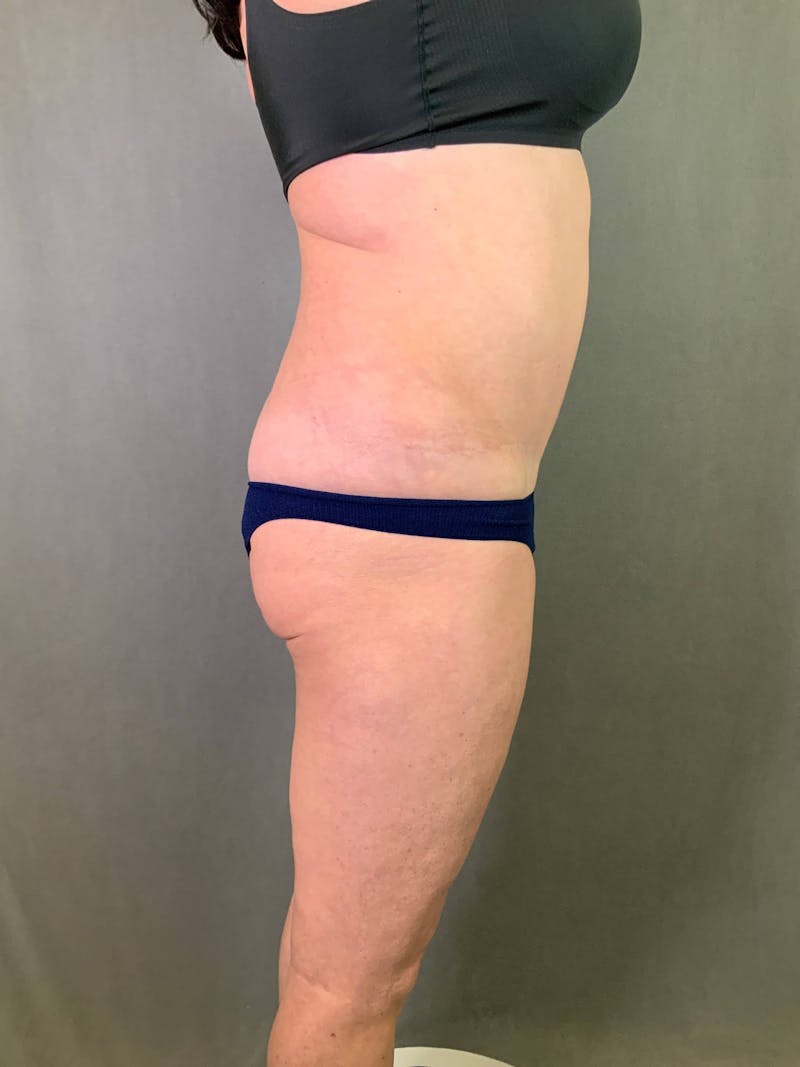 Revision Tummy Tuck Before & After Gallery - Patient 167403258 - Image 5