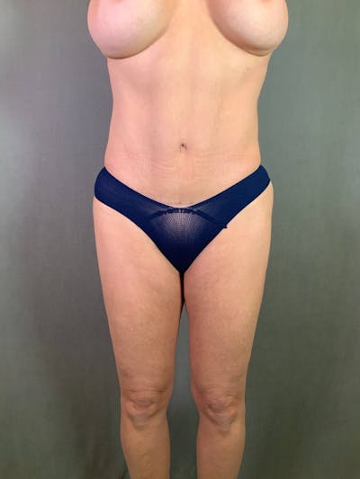 Revision Tummy Tuck Before & After Gallery - Patient 167403258 - Image 2