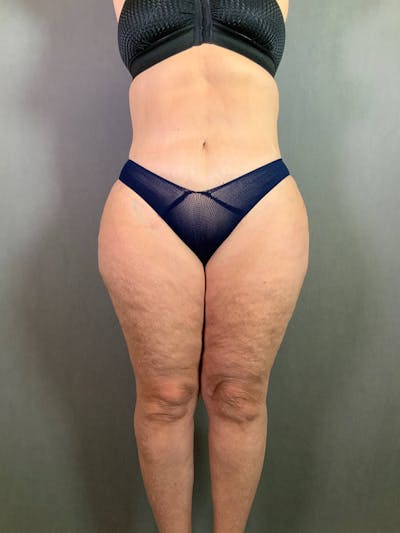 Revision Tummy Tuck Before & After Gallery - Patient 167403260 - Image 2