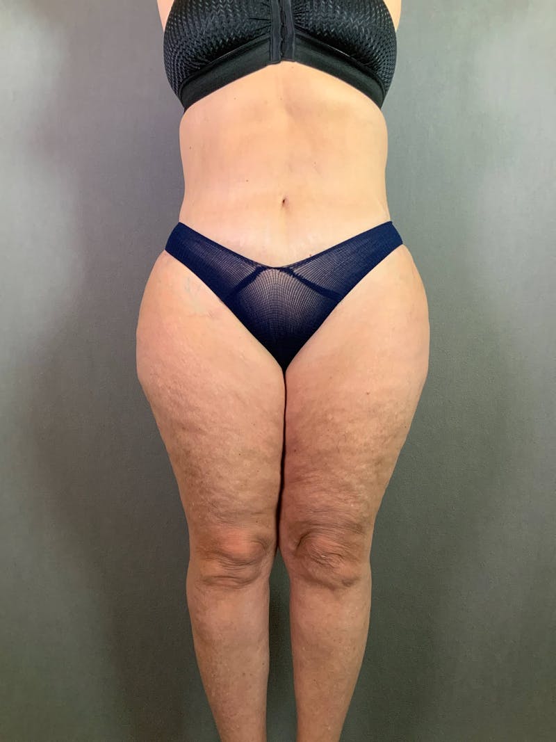 Revision Tummy Tuck Before & After Gallery - Patient 167403260 - Image 2