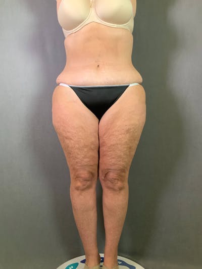Revision Tummy Tuck Before & After Gallery - Patient 167403260 - Image 1