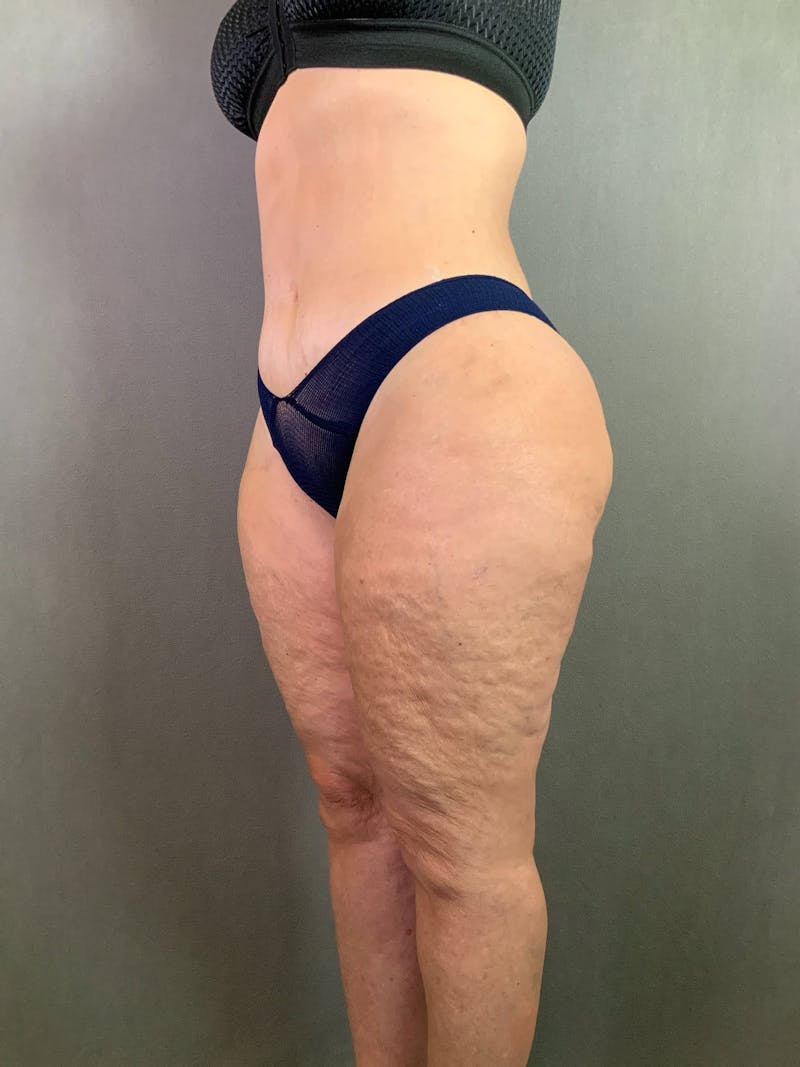 Revision Tummy Tuck Before & After Gallery - Patient 167403260 - Image 4