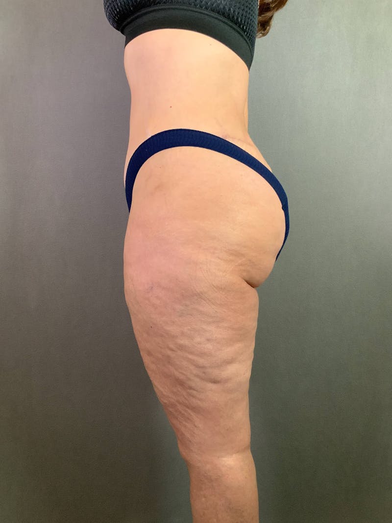 Revision Tummy Tuck Before & After Gallery - Patient 167403260 - Image 6