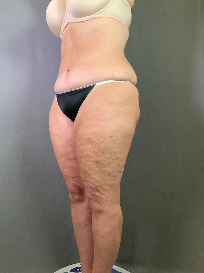 Revision Tummy Tuck Before & After Gallery - Patient 167403260 - Image 3