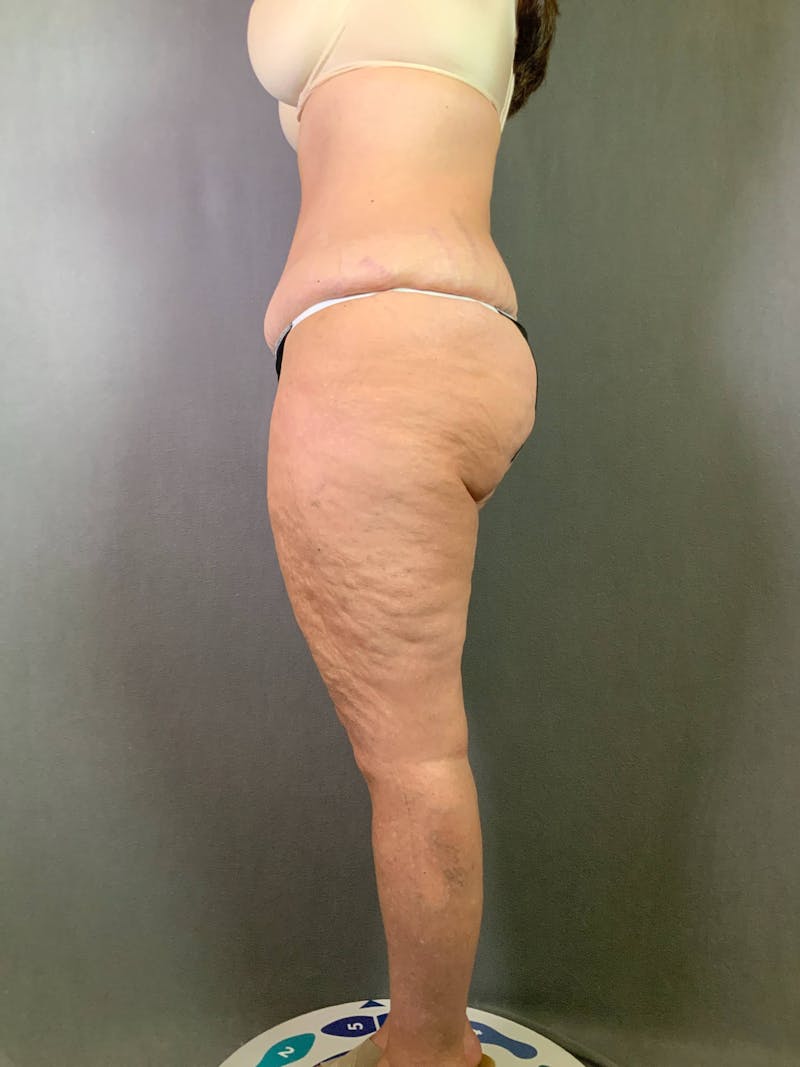 Revision Tummy Tuck Before & After Gallery - Patient 167403260 - Image 5