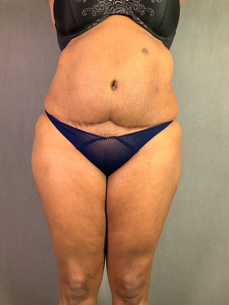 Revision Tummy Tuck Before & After Gallery - Patient 167403264 - Image 1