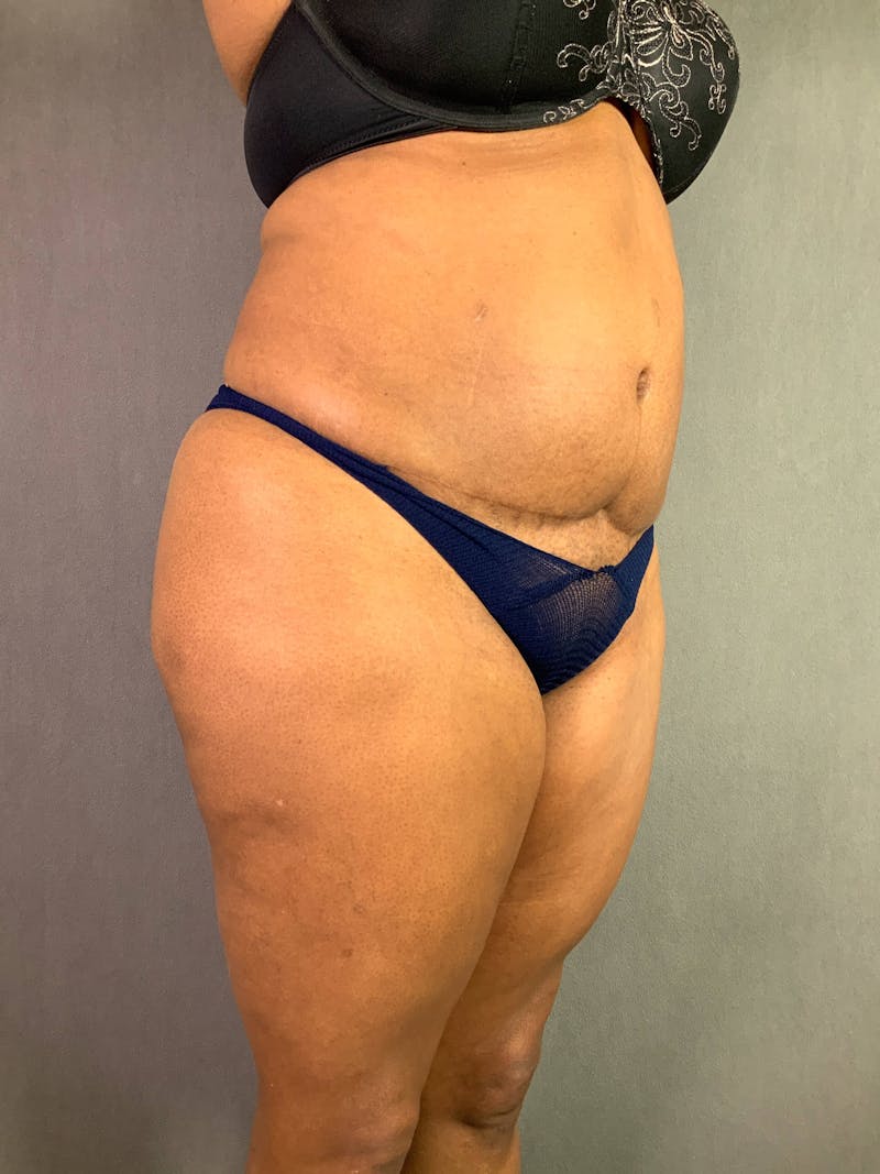 Revision Tummy Tuck Before & After Gallery - Patient 167403264 - Image 3
