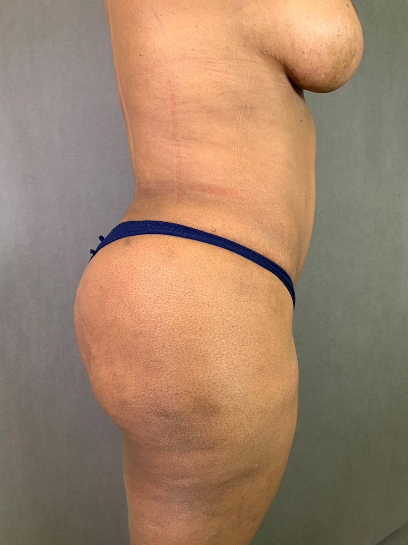 Revision Tummy Tuck Before & After Gallery - Patient 167403264 - Image 6