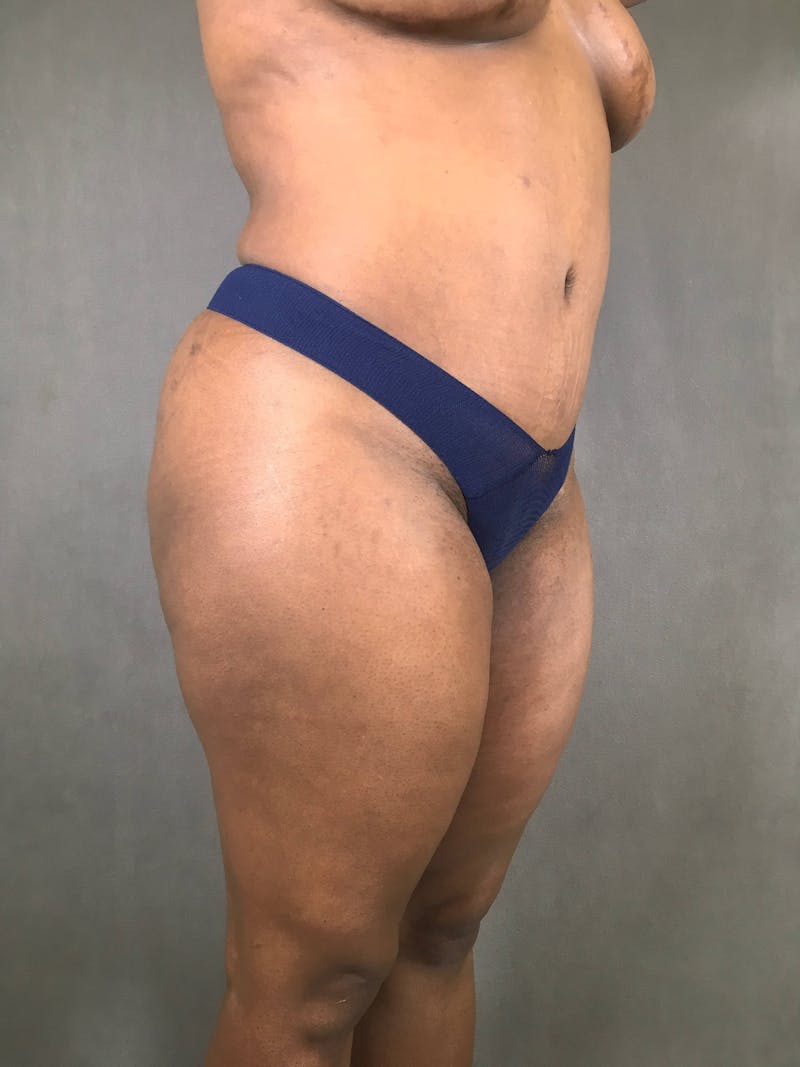 Revision Tummy Tuck Before & After Gallery - Patient 167403265 - Image 4