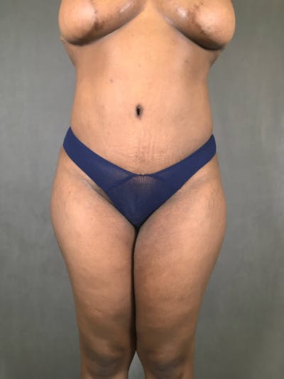 Revision Tummy Tuck Before & After Gallery - Patient 167403265 - Image 2