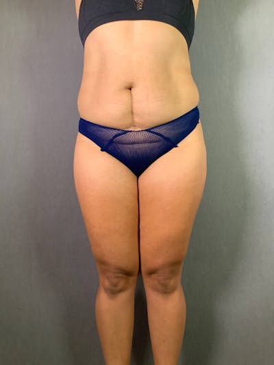 Standard Abdominoplasty Before & After Gallery - Patient 167403278 - Image 1