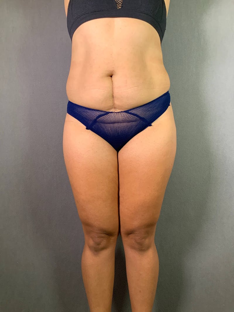 Standard Abdominoplasty Before & After Gallery - Patient 167403278 - Image 1