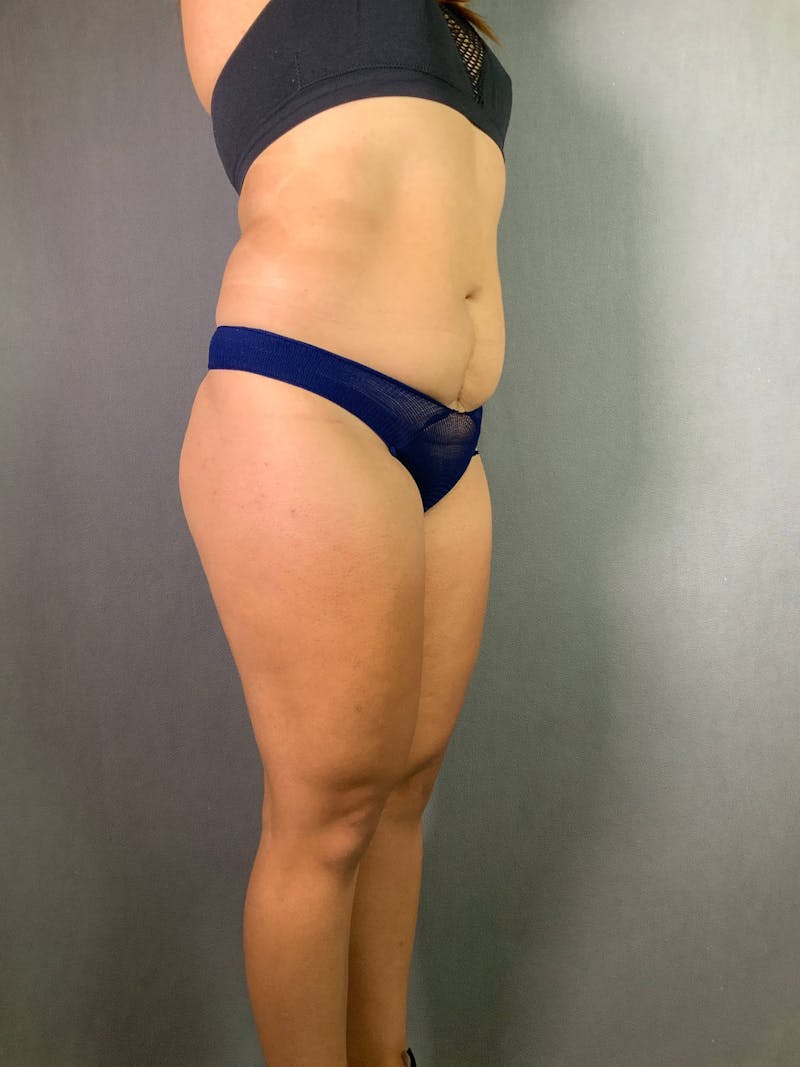 Standard Abdominoplasty Before & After Gallery - Patient 167403278 - Image 3