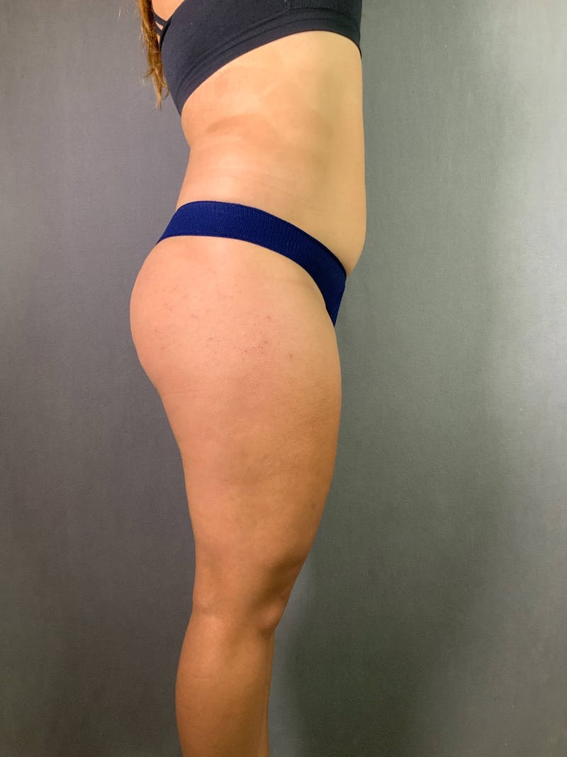 Standard Abdominoplasty Before & After Gallery - Patient 167403278 - Image 5