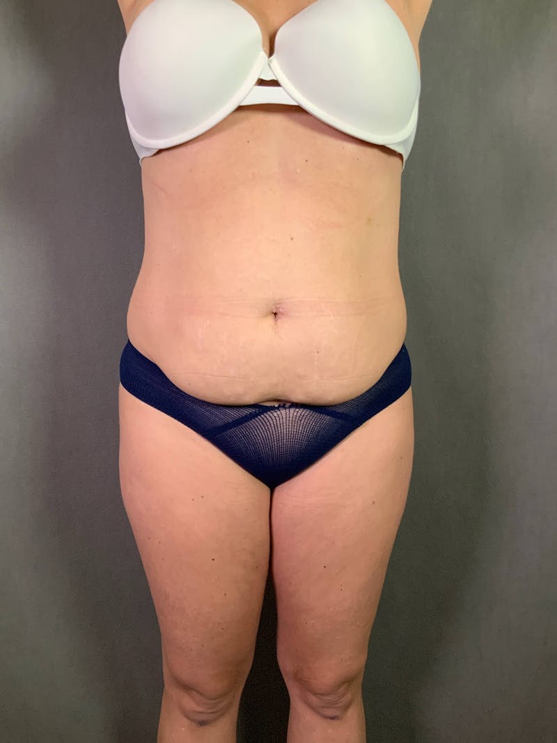 Standard Abdominoplasty Before & After Gallery - Patient 167403279 - Image 1