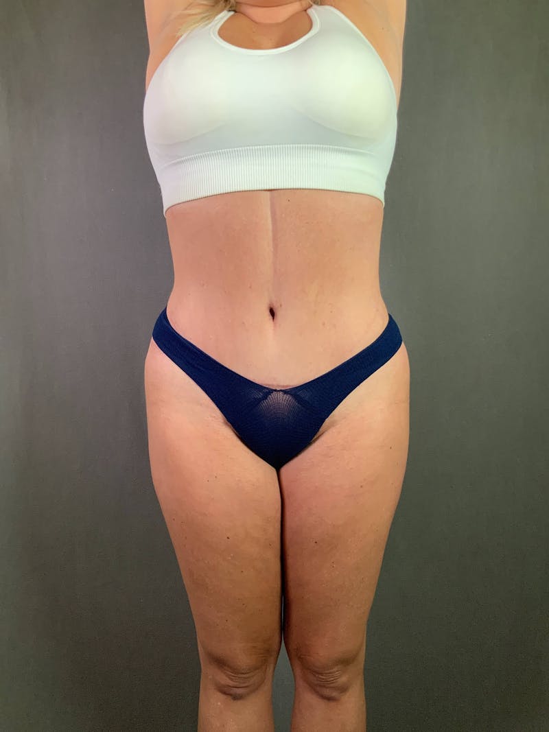 Standard Abdominoplasty Before & After Gallery - Patient 167403279 - Image 2