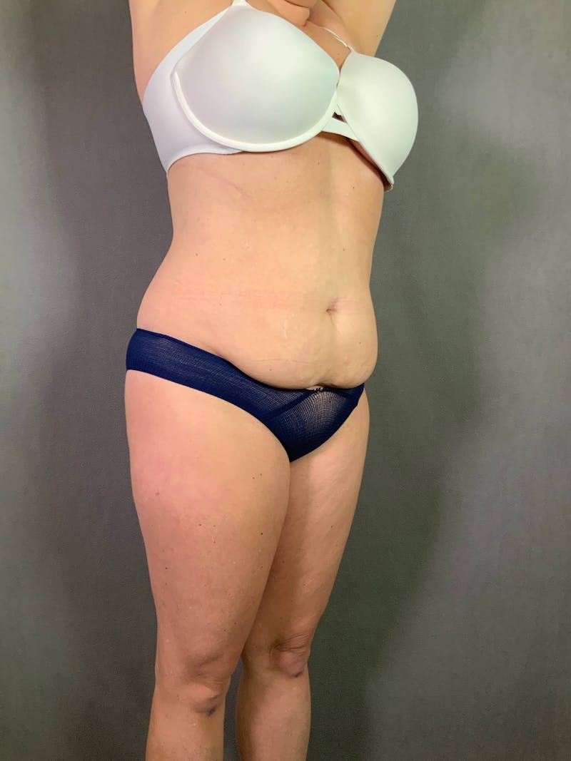Standard Abdominoplasty Before & After Gallery - Patient 167403279 - Image 3