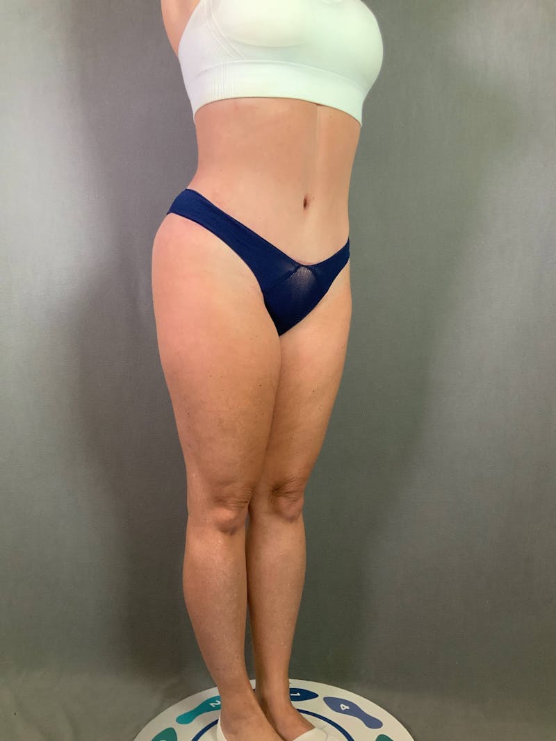 Standard Abdominoplasty Before & After Gallery - Patient 167403279 - Image 4
