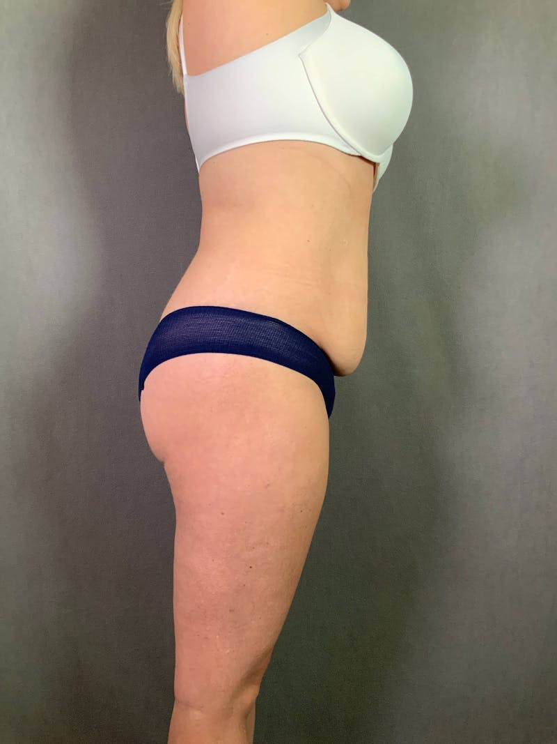 Standard Abdominoplasty Before & After Gallery - Patient 167403279 - Image 5