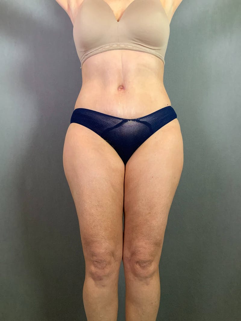 Standard Abdominoplasty Before & After Gallery - Patient 167403296 - Image 2