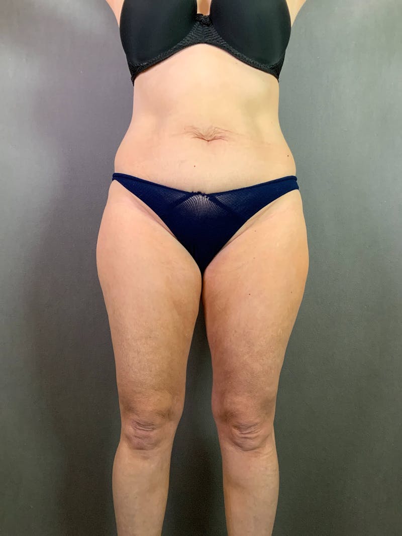Standard Abdominoplasty Before & After Gallery - Patient 167403296 - Image 1