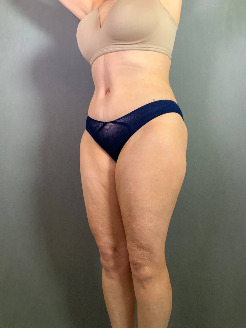 Standard Abdominoplasty Before & After Gallery - Patient 167403296 - Image 4