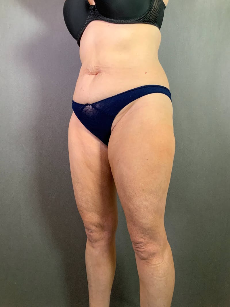 Standard Abdominoplasty Before & After Gallery - Patient 167403296 - Image 3