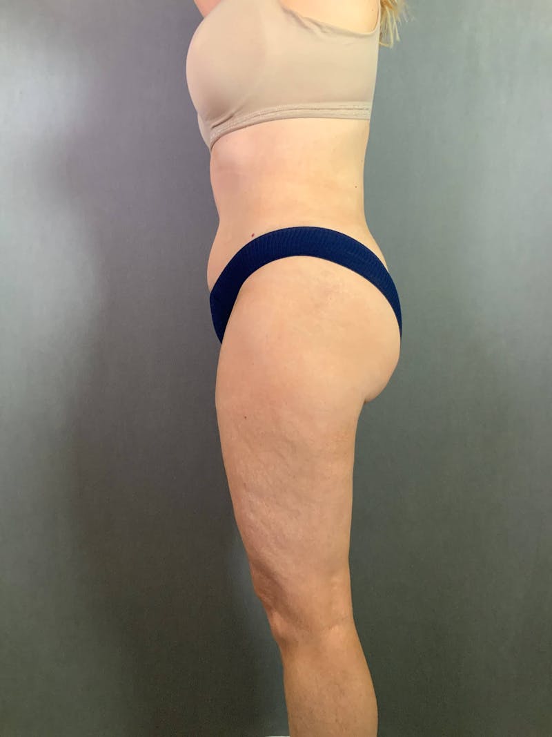 Standard Abdominoplasty Before & After Gallery - Patient 167403296 - Image 6
