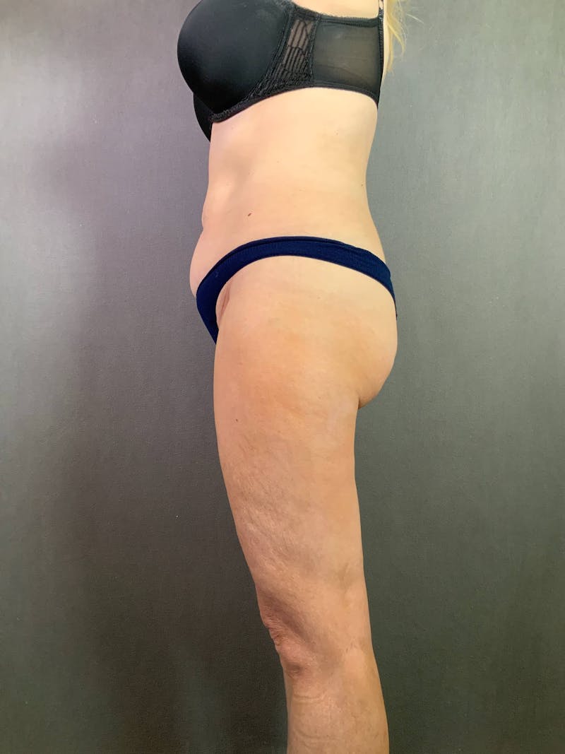 Standard Abdominoplasty Before & After Gallery - Patient 167403296 - Image 5