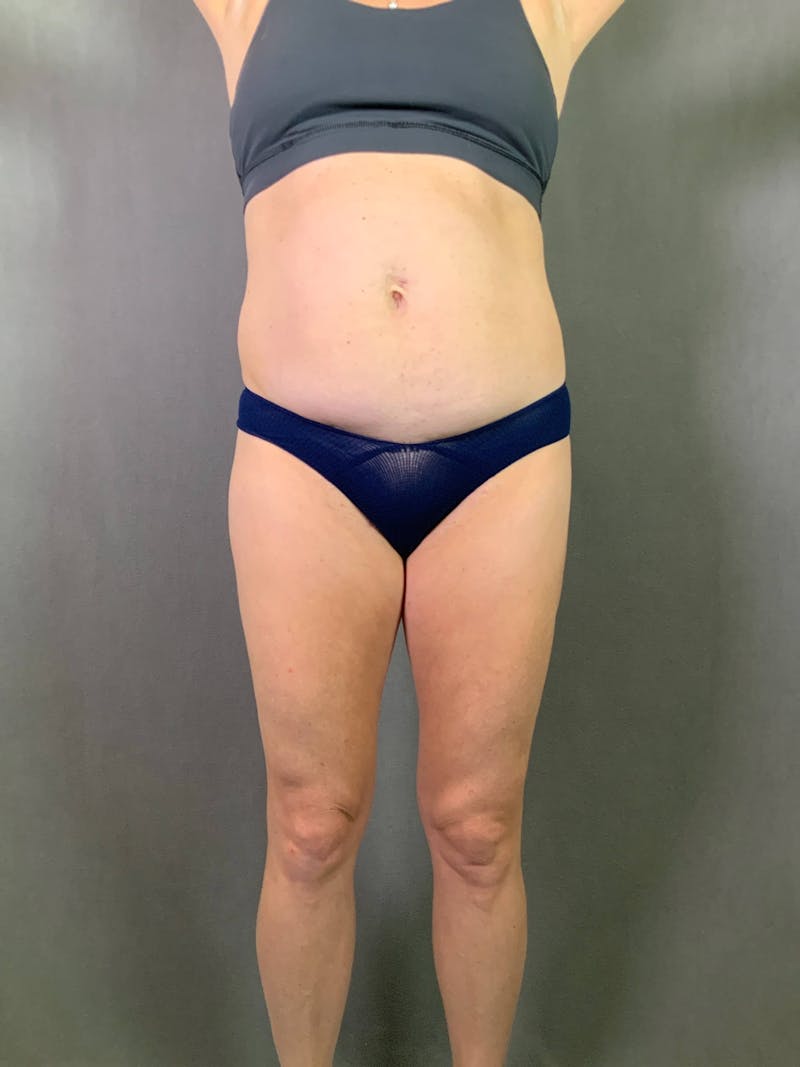Standard Abdominoplasty Before & After Gallery - Patient 167403297 - Image 1
