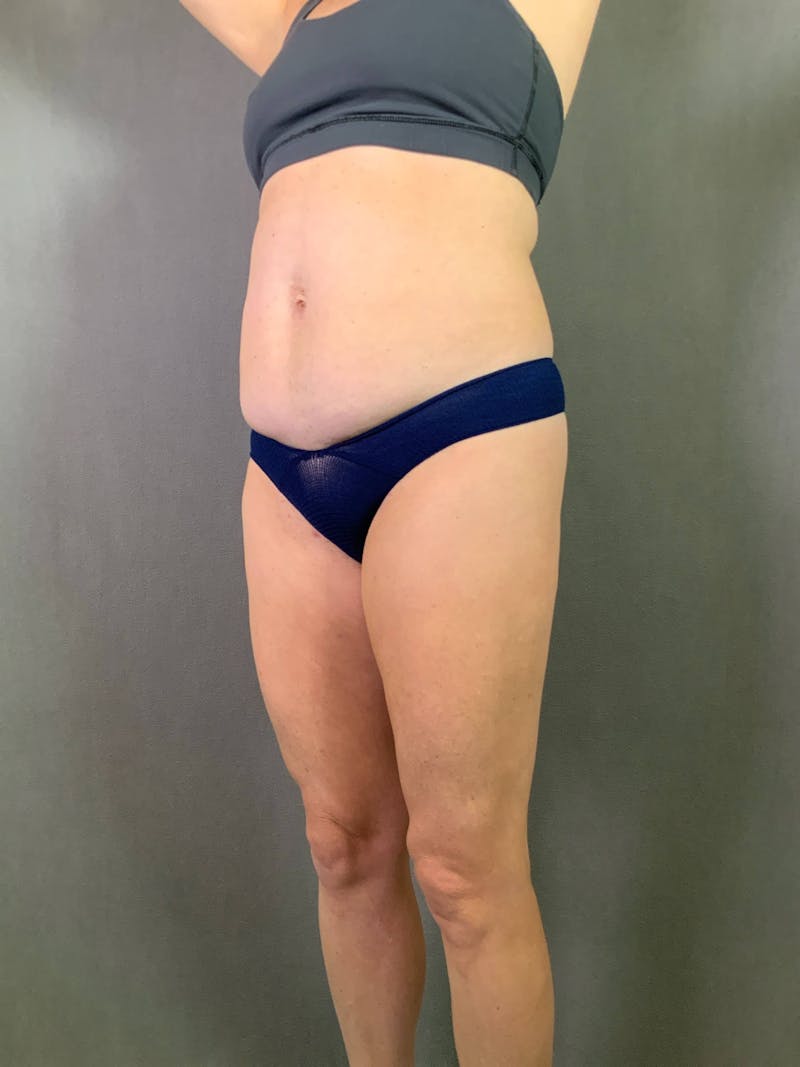 Standard Abdominoplasty Before & After Gallery - Patient 167403297 - Image 3