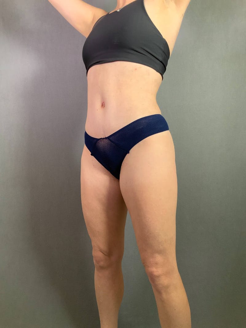 Standard Abdominoplasty Before & After Gallery - Patient 167403297 - Image 4