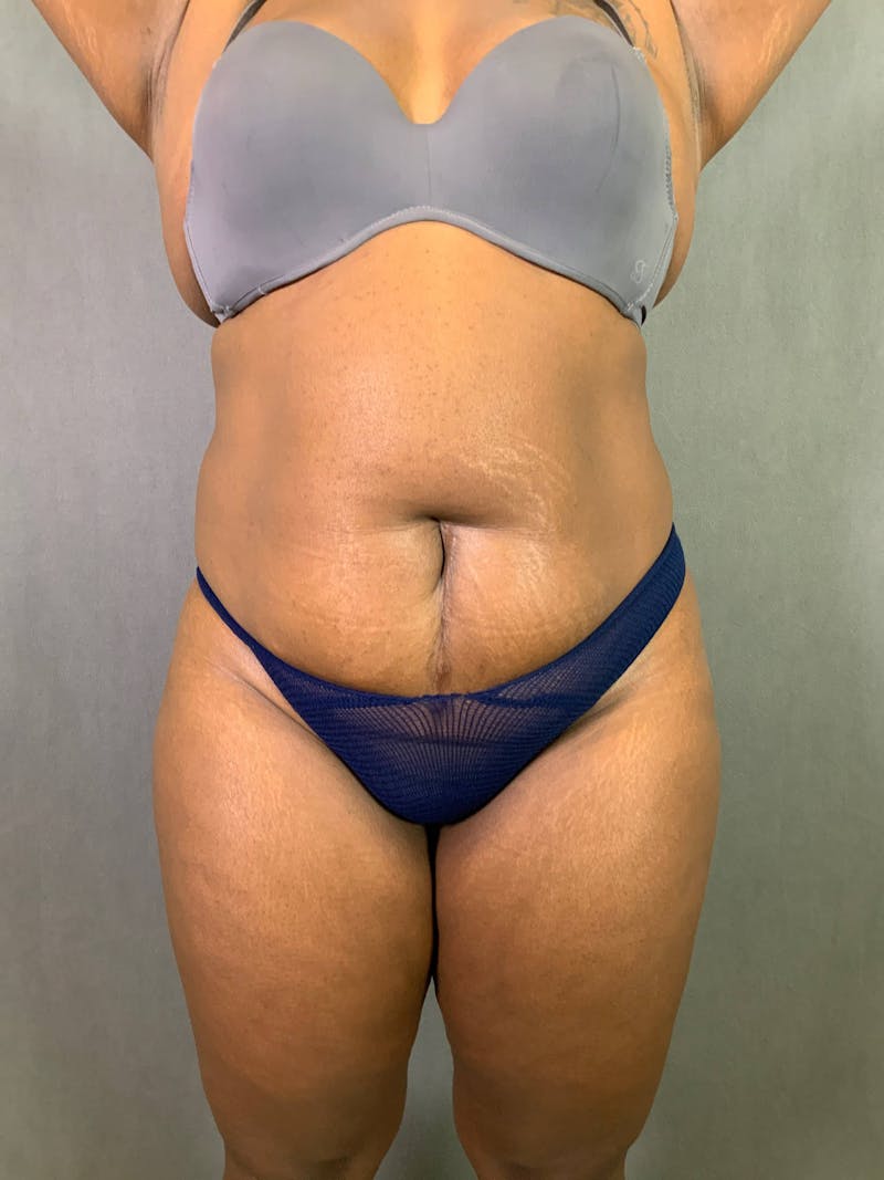 Standard Abdominoplasty Before & After Gallery - Patient 167403298 - Image 1