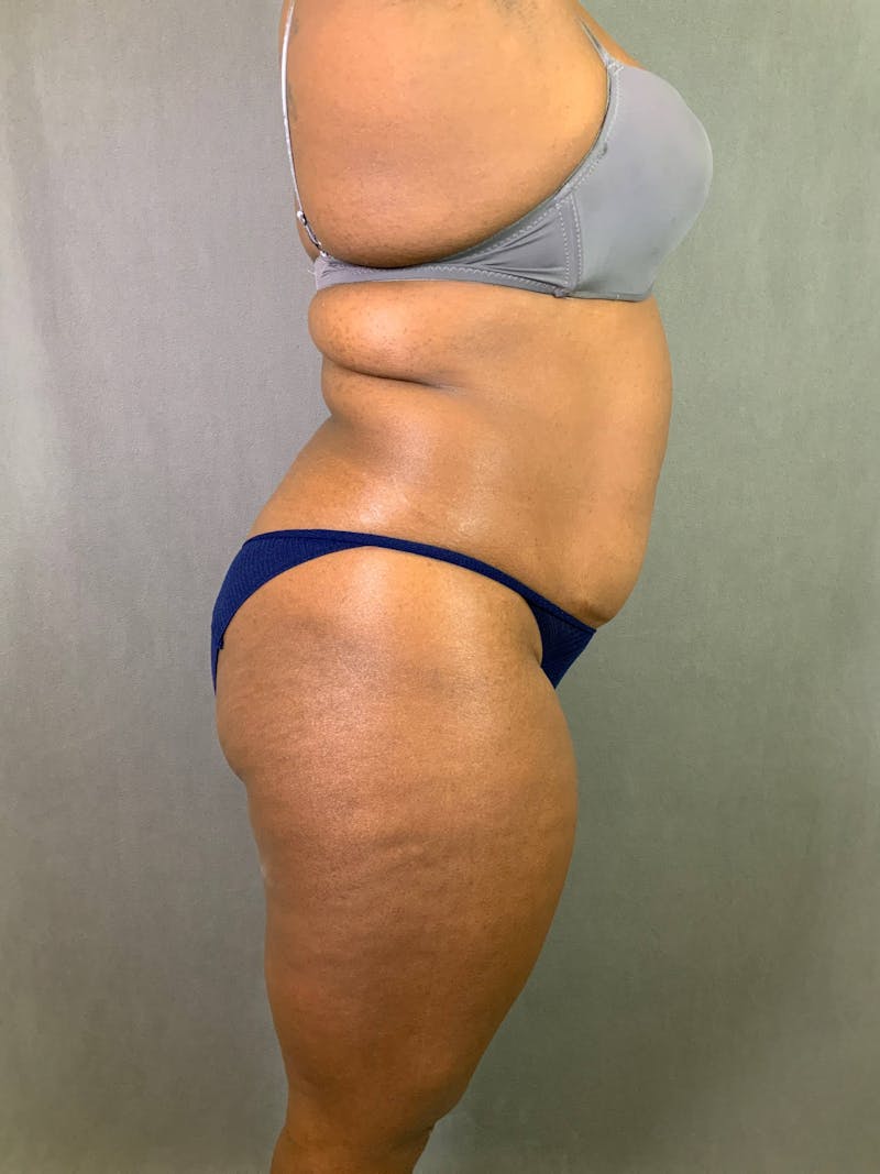 Standard Abdominoplasty Before & After Gallery - Patient 167403298 - Image 5